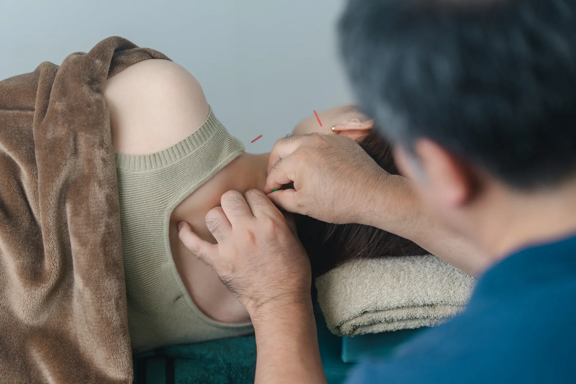 実際に鍼治療を体験して